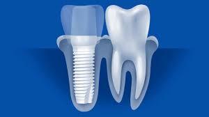 Implant en ceramique